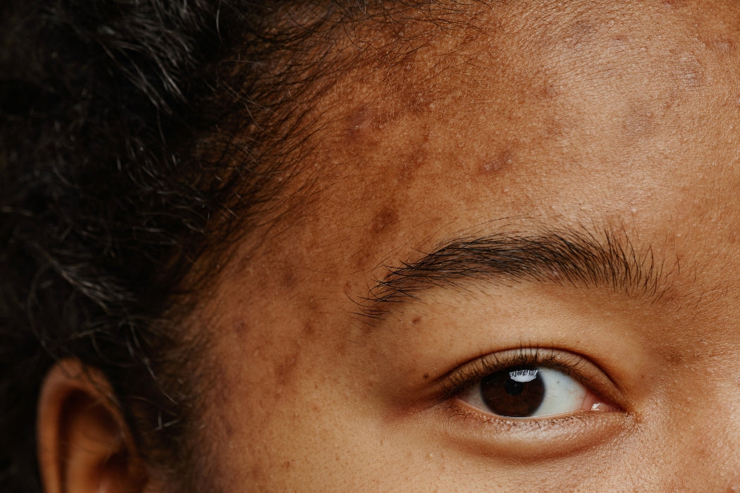 Acne adulta feminina como tratar