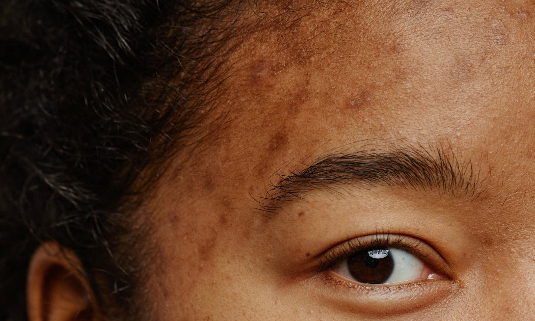 Acne adulta feminina como tratar