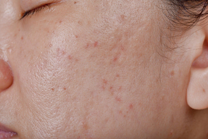 Acne adulta: tratamento e causa