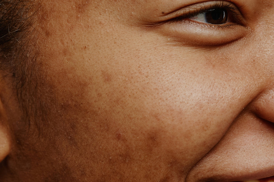 Como reduzir manchas, marcas e cicatrizes de acne de forma inteligente