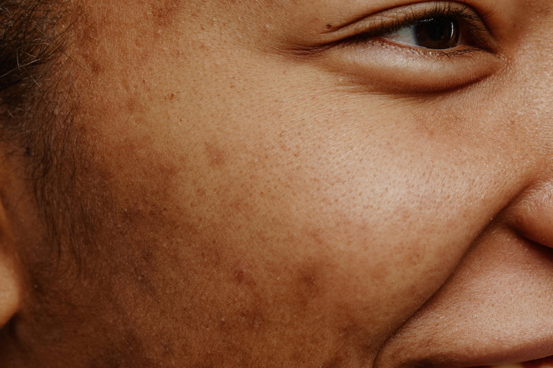 Como reduzir manchas, marcas e cicatrizes de acne de forma inteligente