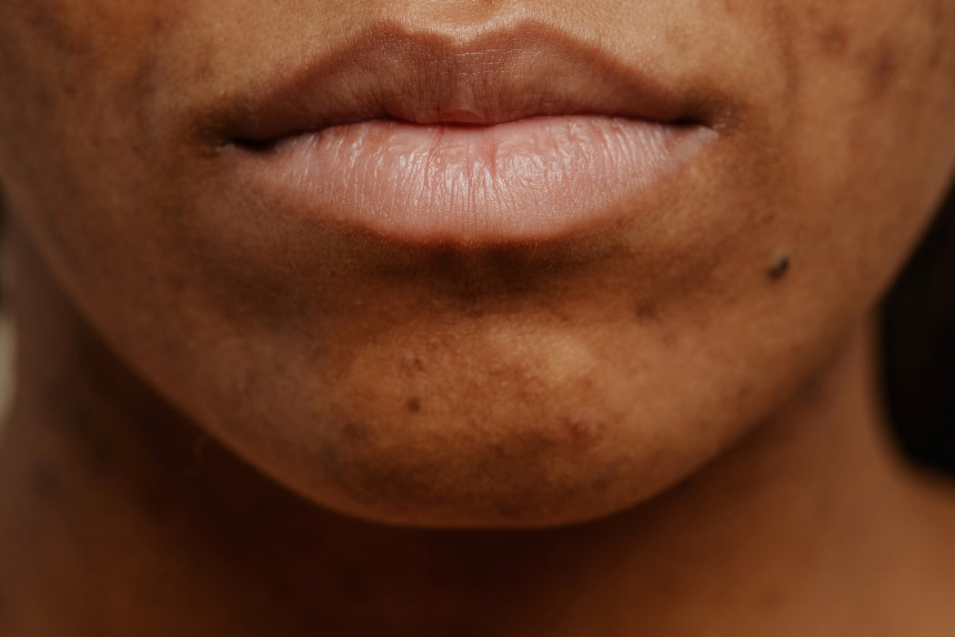 Acne hormonal no queixo: como identificar pelo ciclo, o que piora e quais ativos ajudam