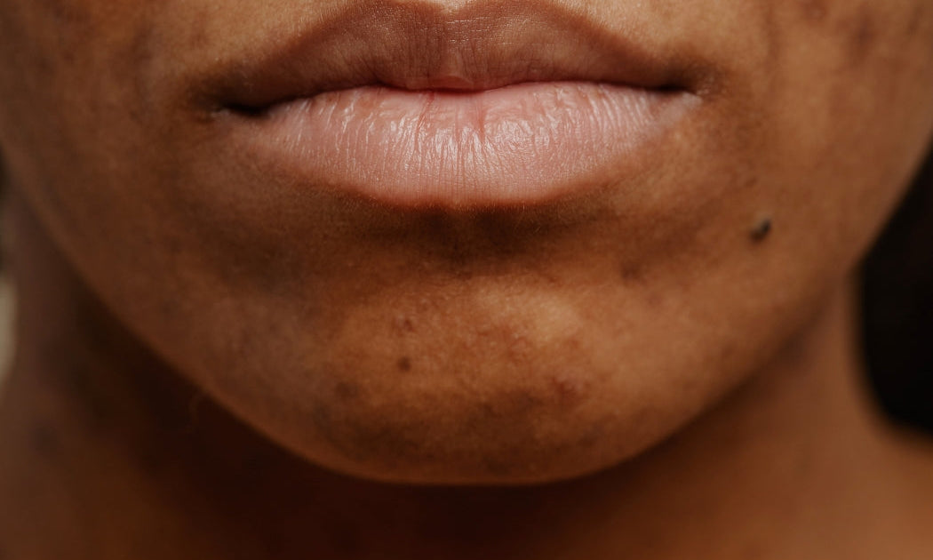 Acne hormonal no queixo: como identificar pelo ciclo, o que piora e quais ativos ajudam