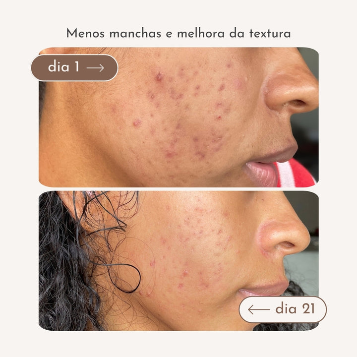 Redução de manchas de acne