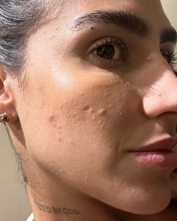 Antes Any Kit Skin Quer antes