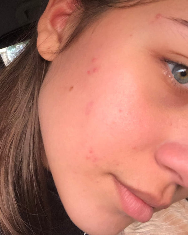 Antes Narin Kit Skin Quer antes