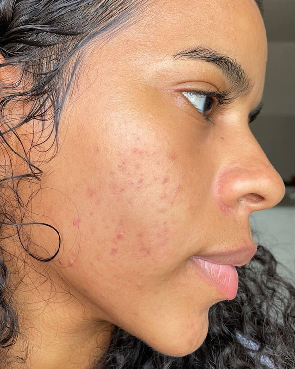 Resultado Bruna Kit Skin Quer depois